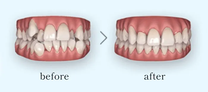 矯正後のイメージがその場でわかるシミュレーション実施中!